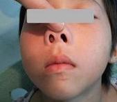 儿童鼻息肉图片 初期图片