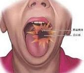 舌咽神经痛