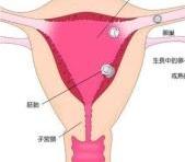 宫颈妊娠