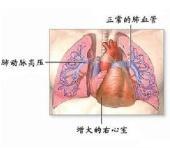 原发性肺动脉高压